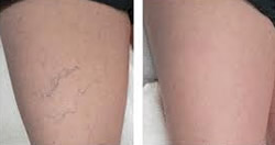 Sclerotherapy Before and After