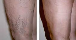 Sclerotherapy Before and After